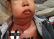 Nazril Hakiki Alami Penyakit Tumor Toraks Butuh Uluran Tangan